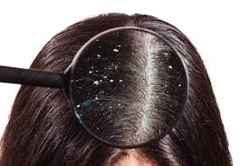 dandruff